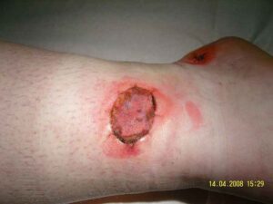 Effects of Radioactive Waste on Humans: Cutaneous Radiation Injury (Credit: Ericalens 2008 .CC BY-SA 3.0.)
