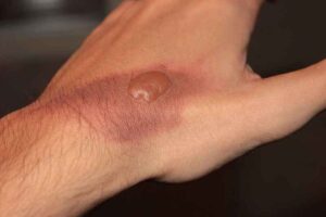 Dangers of Infrared Waves: Skin Damage (Credit: Themidget17 2016 .CC BY-SA 4.0.)