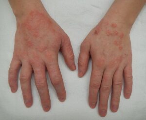 Effects of Land Pollution: Dermatitis as a Human Health Ailment Caused by Land Pollution (Credit: James Heilman, MD 2014 .CC BY-SA 4.0.)