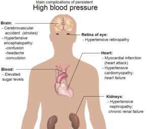 Effects of Noise Pollution: Hypertension as An Attribute of High Blood Pressure Condition, Induced by Prolonged, Excessive Noise (Credit: Mikael Häggström 2019 .CC0 1.0.)