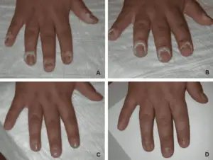 Infrared Light Treatment Benefits: Hand Wart-Inflammation Removed by IR Treatment (Credit: Department of Dermatology and Allergology, Friedrich Schiller University Hospital, Jena, Germany 2004 .CC BY-SA 3.0 DE.)